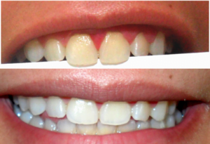 Luxx Amour Teeth Whitener photo review