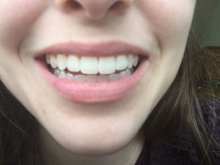 Luxx Amour Teeth Whitener photo review