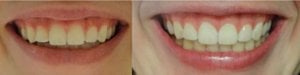Luxx Amour Teeth Whitener photo review