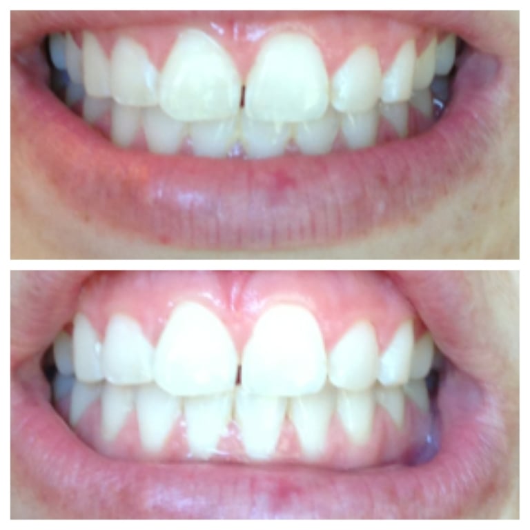 Luxx Amour Teeth Whitener photo review