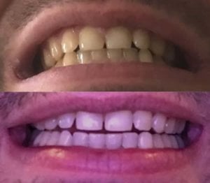 Luxx Amour Teeth Whitener photo review